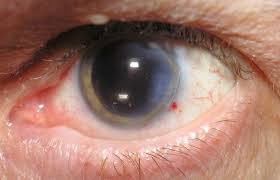 66% din români nu știu că operația de cataractă poate corecta și alte defecte de vedere