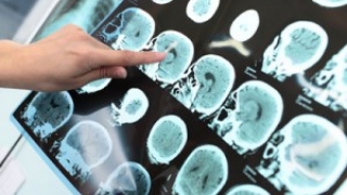 Rezultate promiţătoare împotriva Alzheimer, generate de un nou medicament