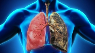 Peste 11.000 de cazuri noi de cancer pulmonar, apărute în România în 2018